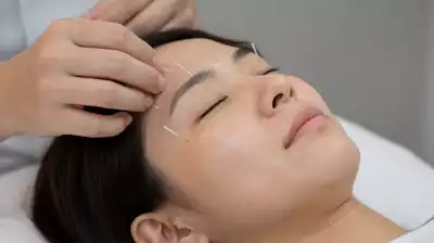 Relaxed patient receiving eye acupuncture treatment